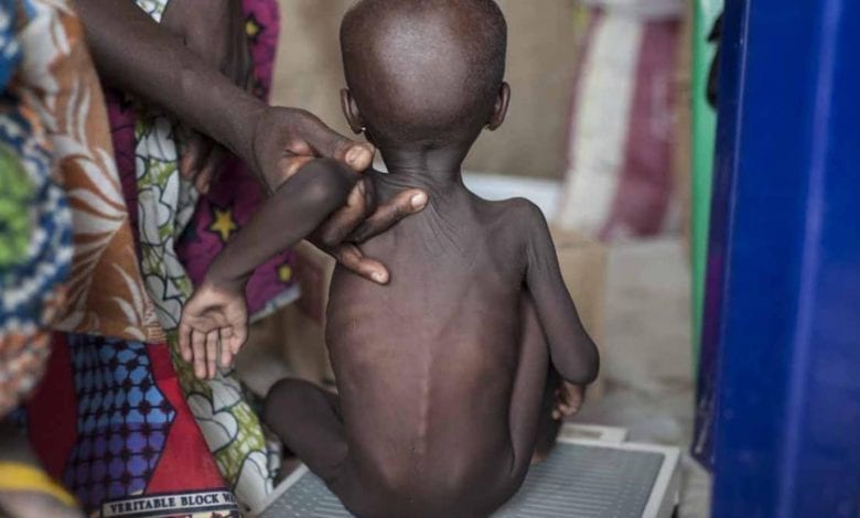 Acute malnutrition