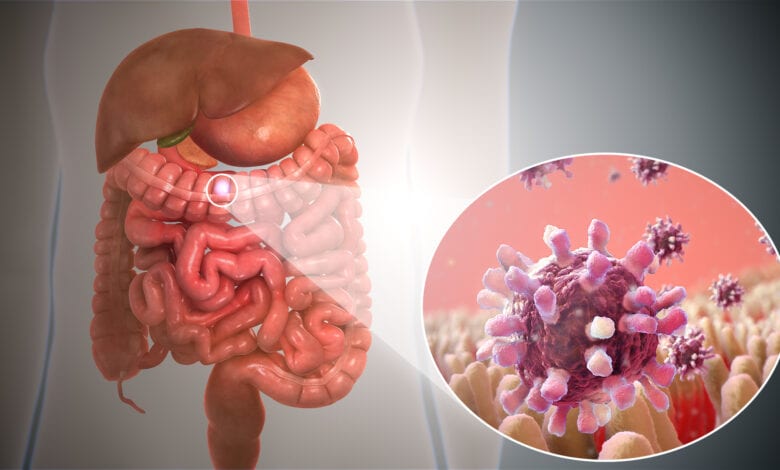 GASTROENTERITIS