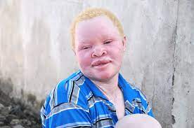 Worls Albinism Day